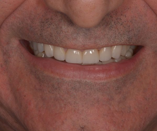 Cópia de coroas esteticas