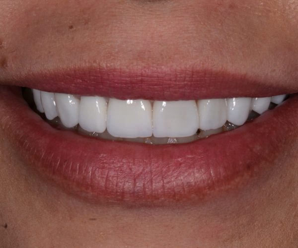 Cópia de lentes porcelana