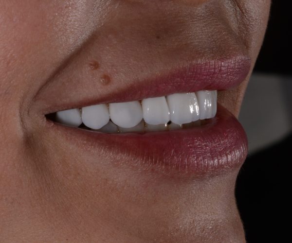 Cópia de lentes porcelana(1)